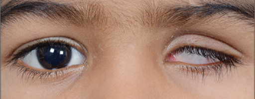 Primary Orbital Implant