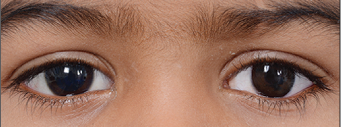 Custom ocular prosthesis