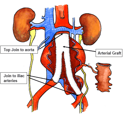 Figure 5: Cartoon illustrating open graft repair