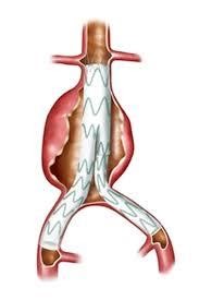 Figure 7: Cartoon picture of EVAR