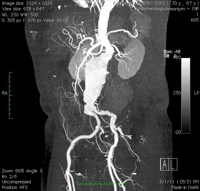 Figure 2. CT scan delineates the anatomy of AAA