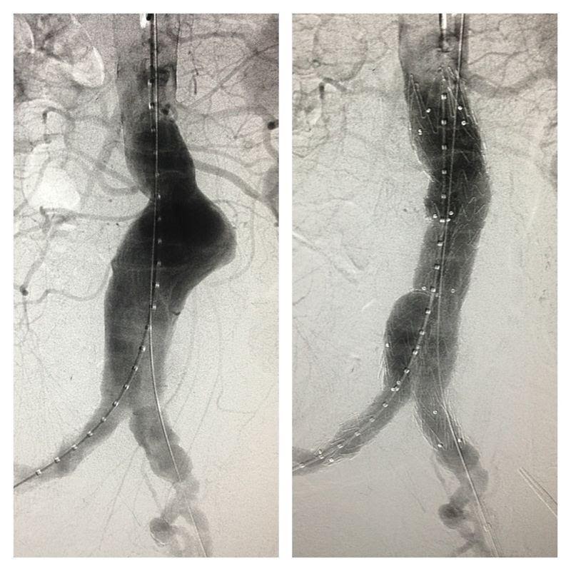 Figure 8: Angiographic picture of AAA, pre & post 